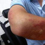 Wat te doen bij pijn in de elleboog bij krachttraining