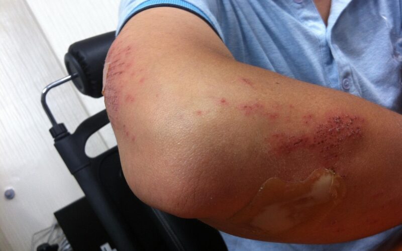 Wat te doen bij pijn in de elleboog bij krachttraining